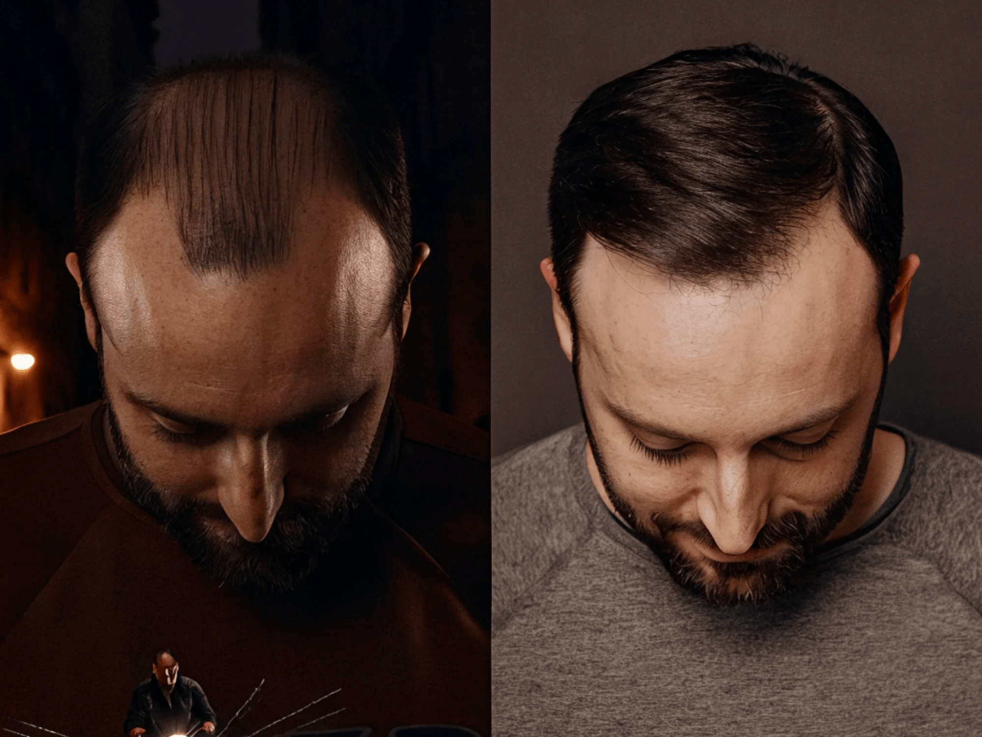 When Can I Use Clippers After Hair Transplant? Complete Timeline