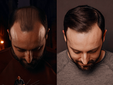 When Can I Use Clippers After Hair Transplant?